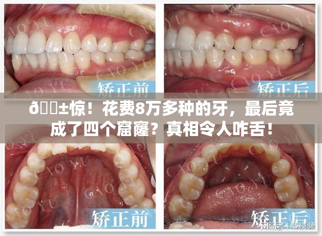 花费8万多种的牙成了四个窟窿